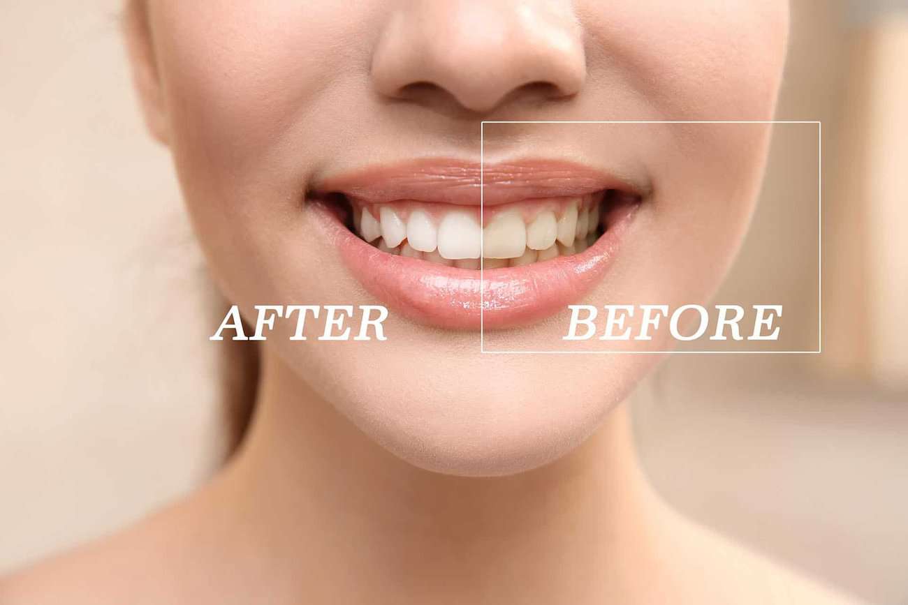 How Can You Maintain a Consistent Smile Shade with Crowns Ellesmere Port?