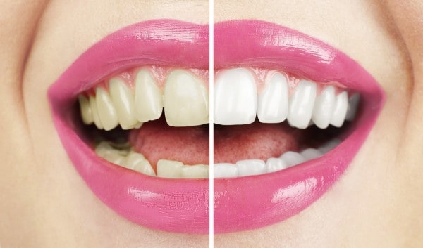 What Early Signs of Oral Cancer Should You Never Ignore Ellesmere Port?