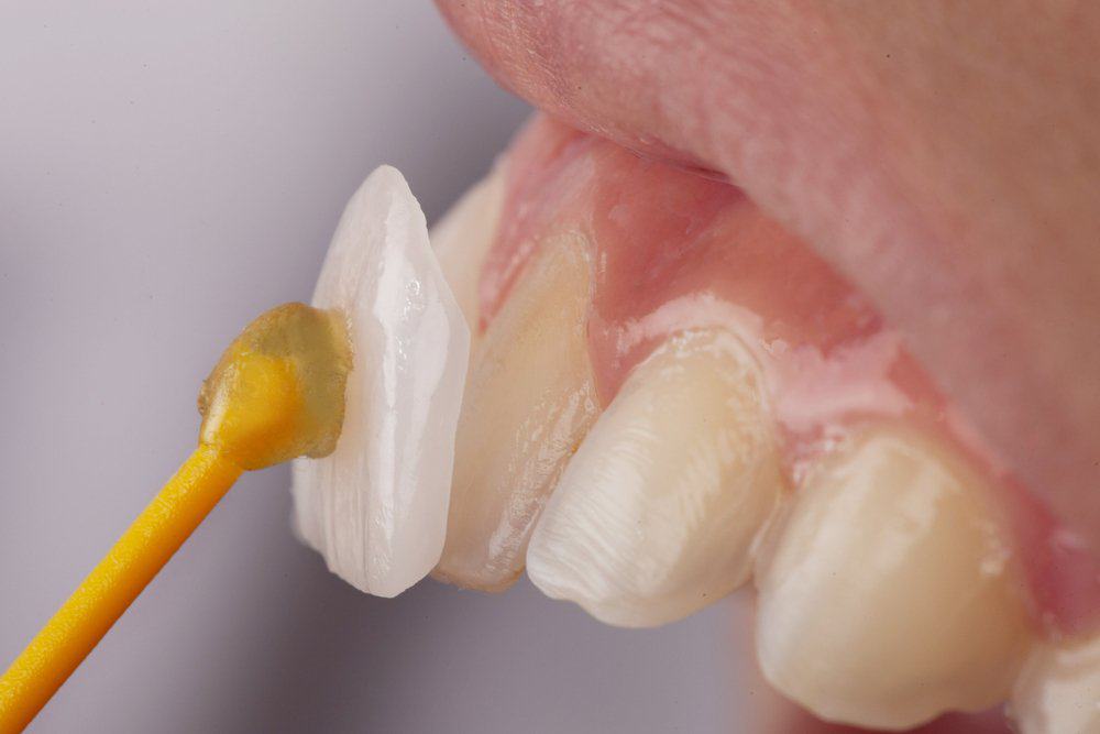 Why Do Dental Crowns Fail or Get Damaged Prematurely Ellesmere Port?