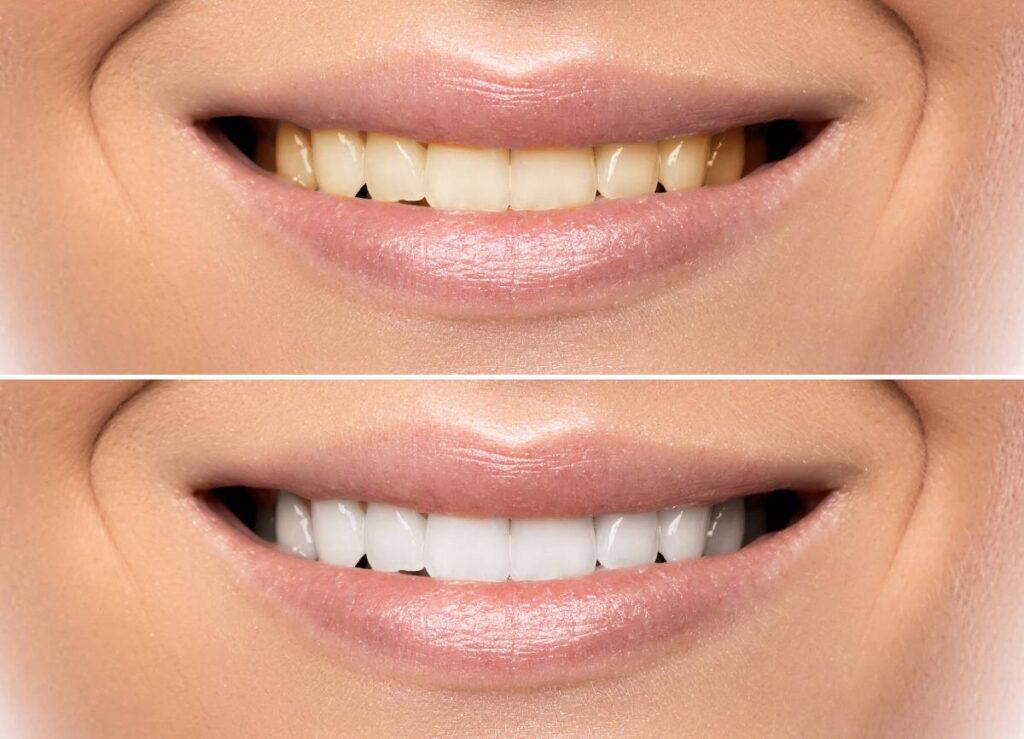 How Can You Protect Your White Smile as a Coffee Lover Ellesmere Port?
