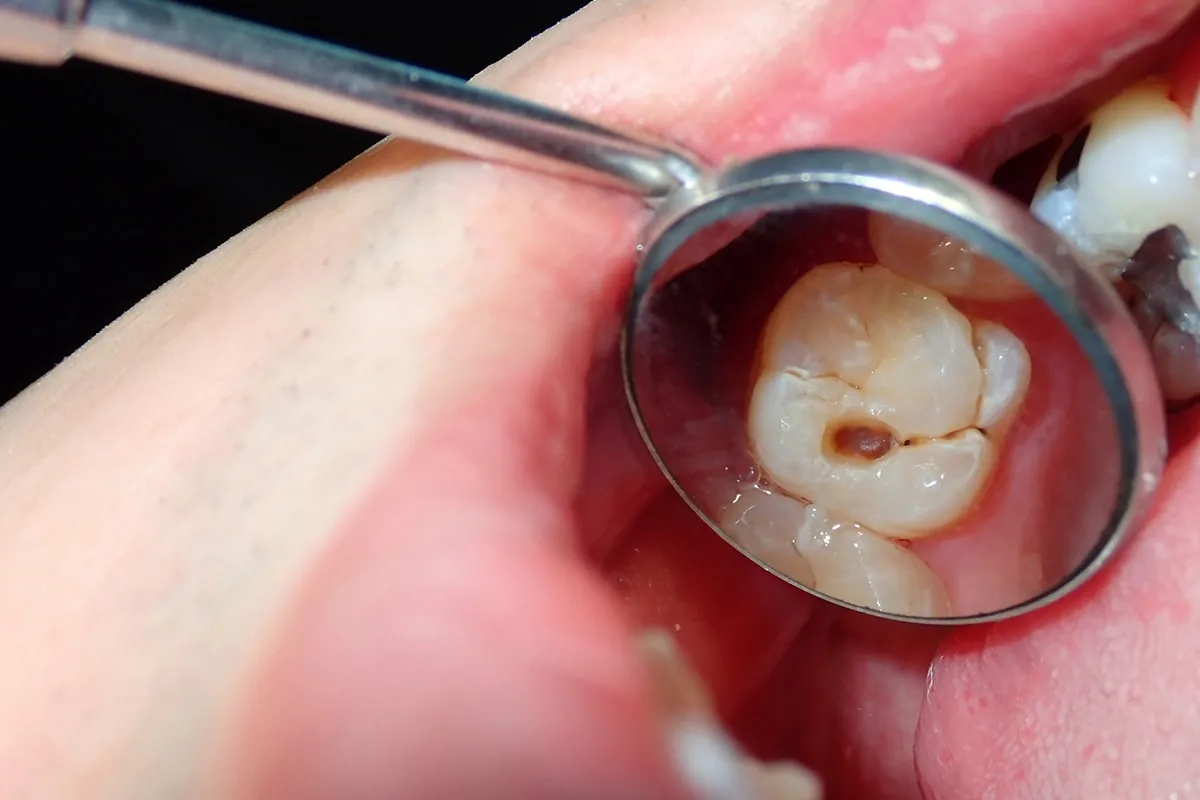 Why Do Teeth Crack? Common Causes to Know Ellesmere Port