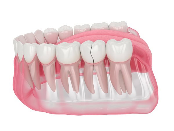 How Can You Manage Pain and Discomfort After a Root Canal Ellesmere Port?