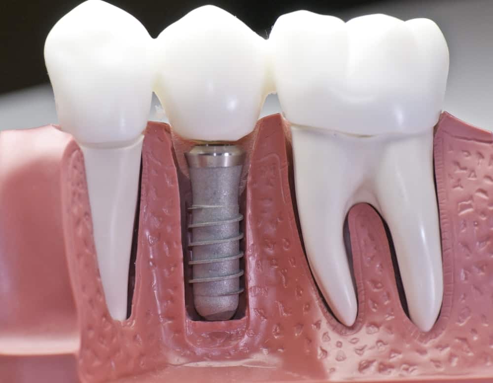 Common Misconceptions About Modern Dental Treatments Ellesmere Port