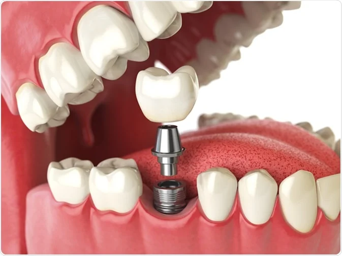 How Do I Decide Which Tooth Replacement Is Right for Me Ellesmere Port?