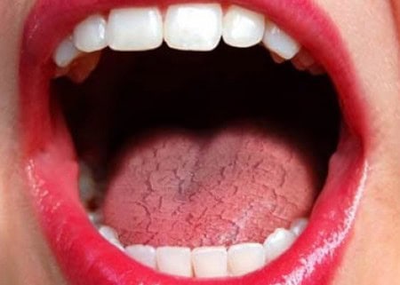 Common Causes of Dry Mouth (Xerostomia) Ellesmere Port