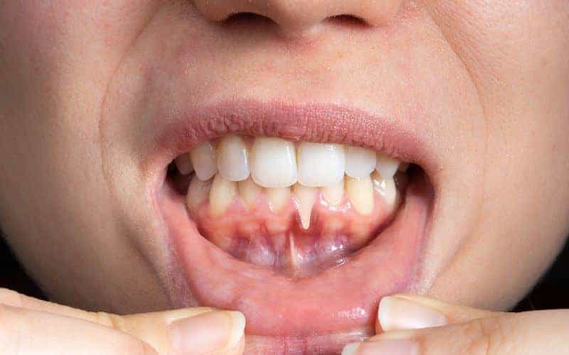 How Can Gum Disease Be Prevented Ellesmere Port?