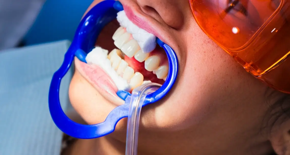 FAQs: Laser Teeth Whitening vs. At-Home Kits Ellesmere Port