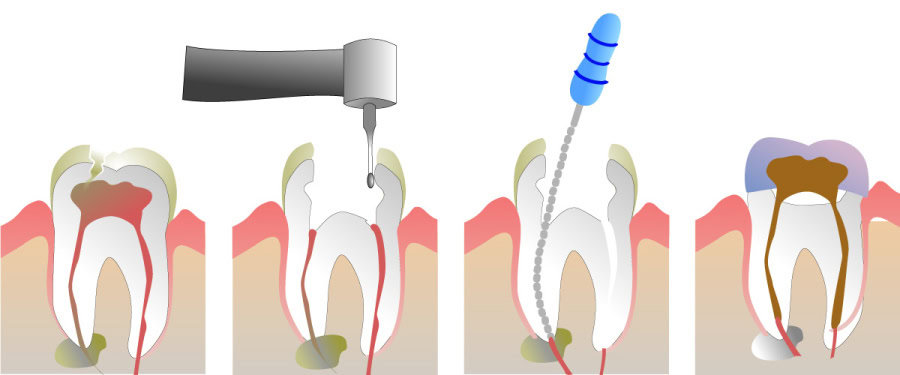 How Do You Properly Care for Your Teeth After a Root Canal Ellesmere Port