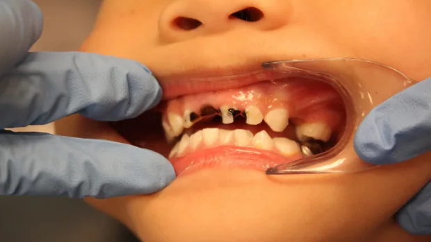 Tips for Keeping Your Child’s Baby Teeth Healthy and Strong Ellesmere Port