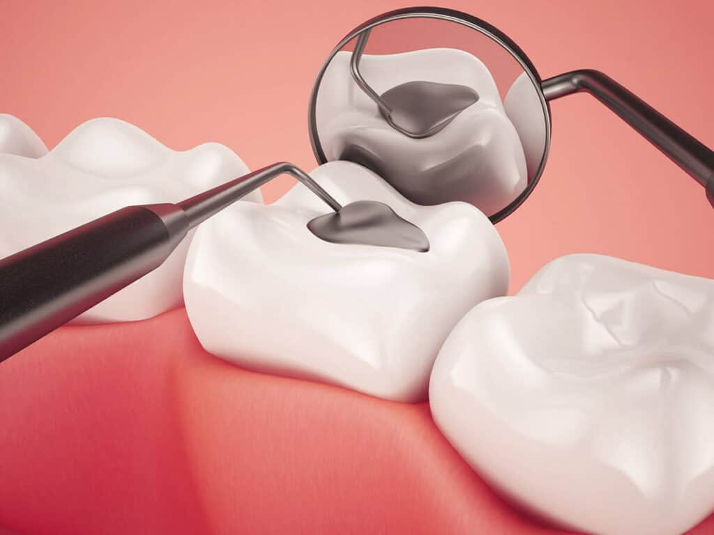 How Can You Prevent Tooth Decay Effectively Ellesmere Port