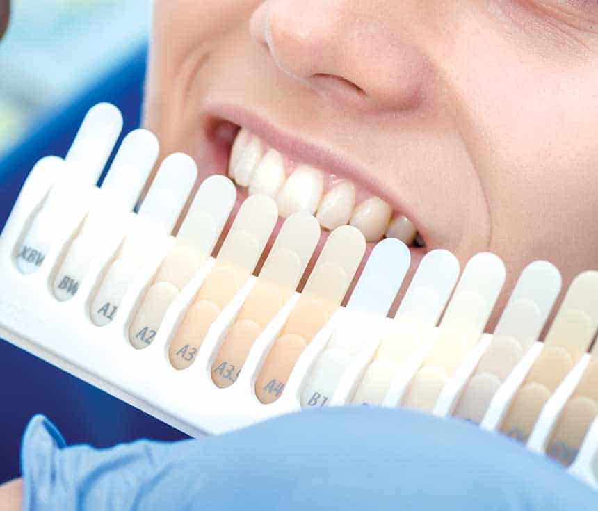Professional vs At-Home Whitening: What You Need to Know Ellesmere Port