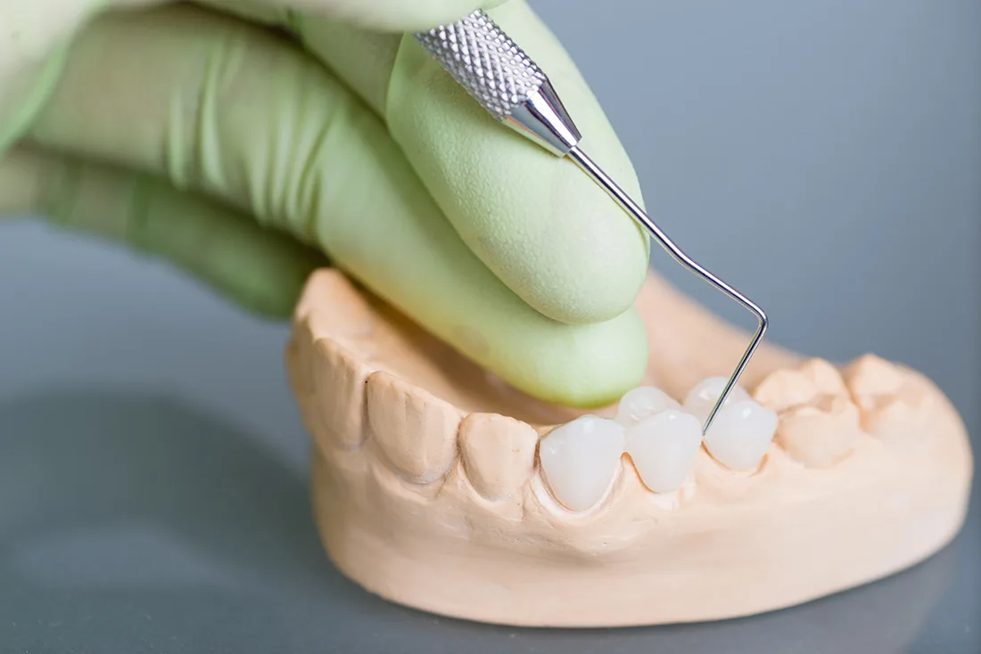 Do Braces Take Years to Show Results Ellesmere Port