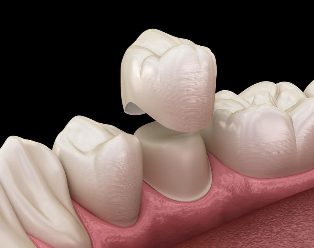 How Can You Prevent Common Dental Crown Problems Ellesmere Port?