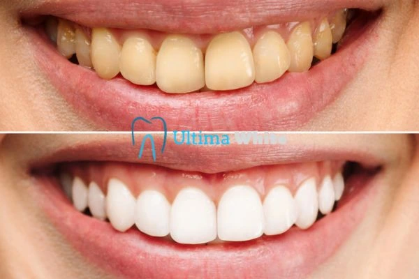 Oral Care Tips for Current and Former Smokers Ellesmere Port