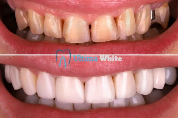 What Makes Instant Teeth Whitening Treatments So Popular Ellesmere Port?