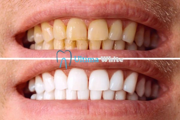 Stained Teeth and Persistent Bad Breath Ellesmere Port