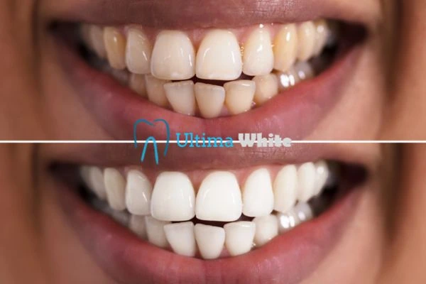 Long lasting results from Ultima White Ellesmere Port